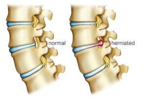 Herniated Disc Treatment Solana Beach