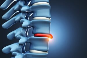 Herniated Disk Treatment Encinitas