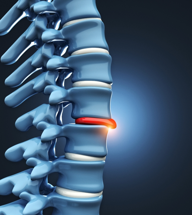 Herniated Disk Treatment in Encinitas: A Natural Path to Pain Relief