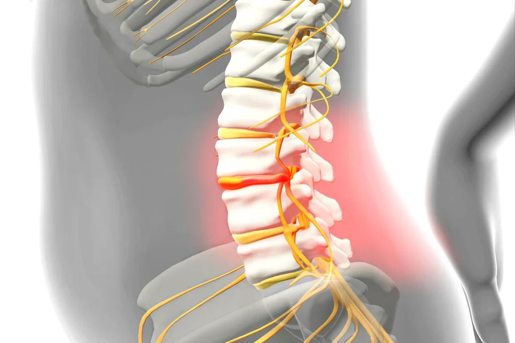 Understanding Herniated Disk Treatment in Encinitas: What Are Your Options?