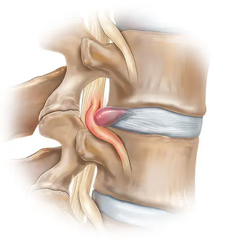 Herniated Disk Treatment Del Mar