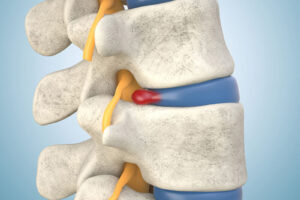 Herniated Disk Treatment Encinitas