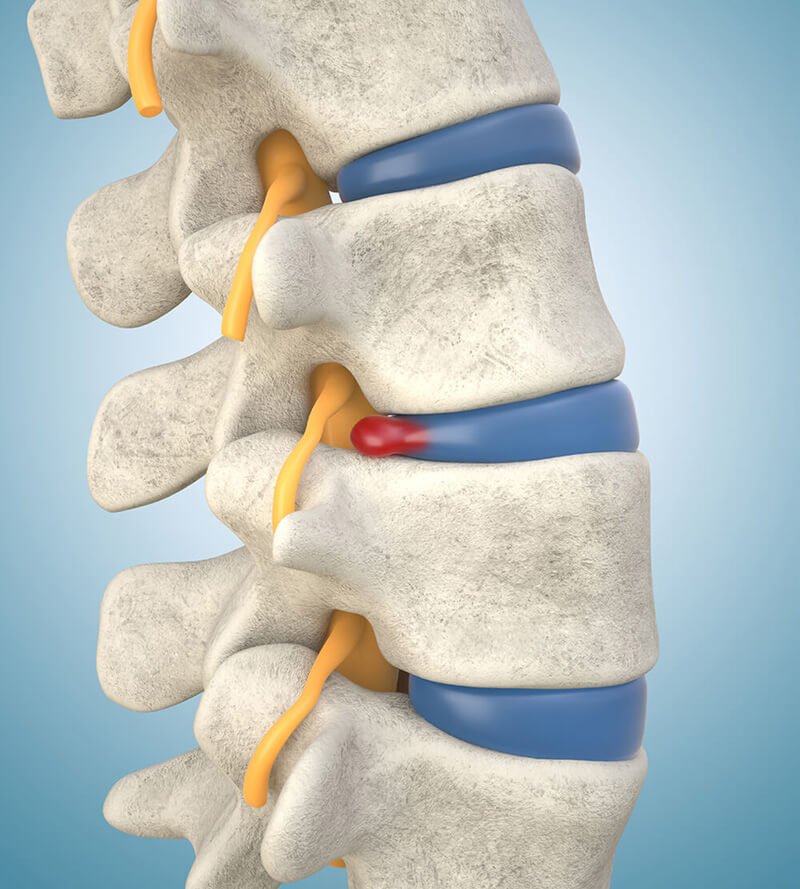 Why Chiropractic Care Is a Safe Choice for Herniated Disk Treatment in Encinitas