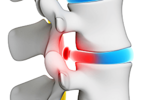 Herniated Disk Treatment Solana Beach