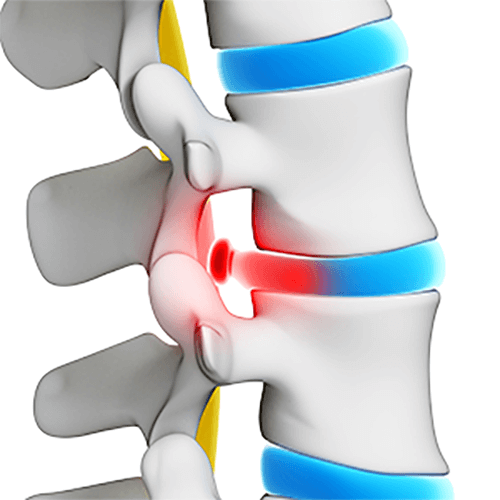 Herniated Disk Treatment in Solana Beach: What Every Patient Should Know
