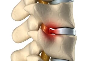 Herniated Disk Treatment Carlsbad