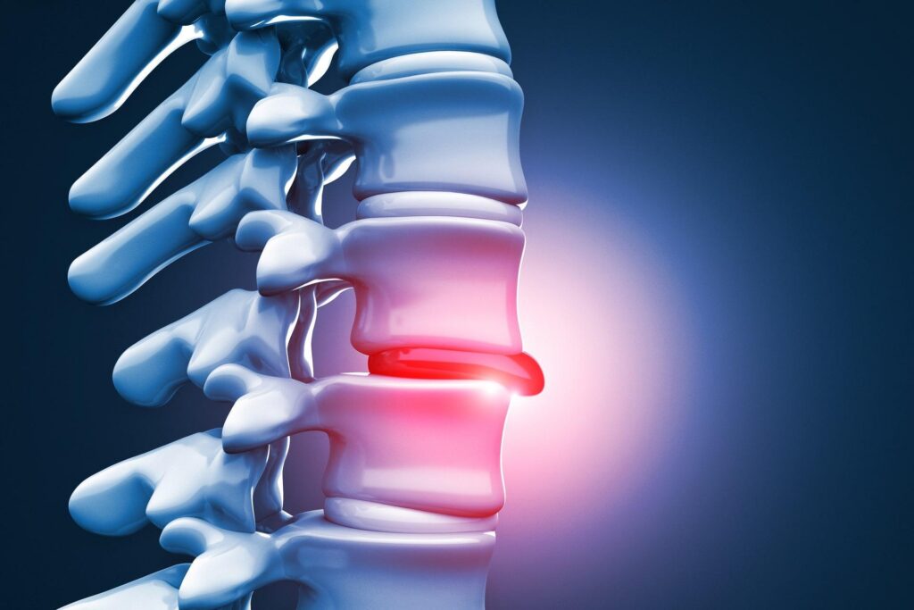 Herniated Disk Treatment in Encinitas: What to Expect During Recovery