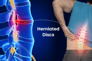 Herniated Disk Treatment Solana Beach