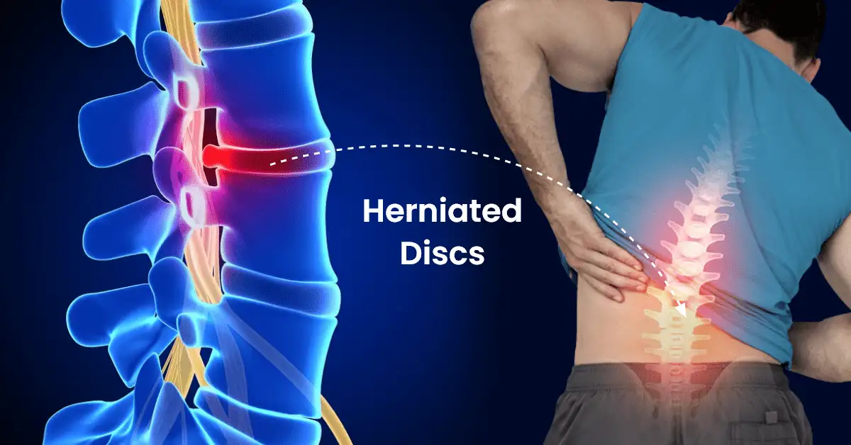 Herniated Disk Treatment Solana Beach