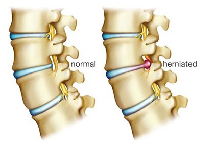Herniated Disk Treatment Solana Beach