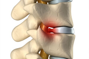 Herniated Disk Treatment Encinitas