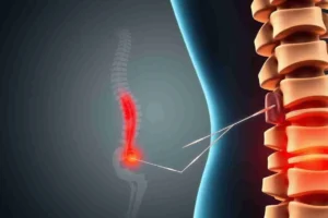 Herniated Disk Treatment Encinitas