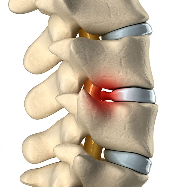 Herniated Disk Treatment Encinitas