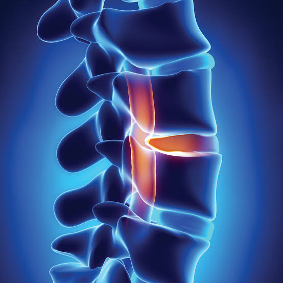 Herniated Disk Treatment Del Mar
