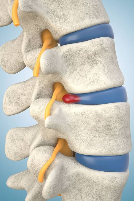 Herniated Disk Treatment Solana Beach