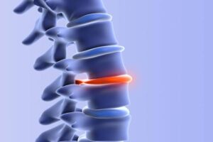 Herniated Disk Treatment Carlsbad