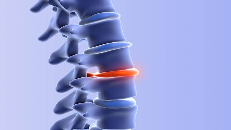 Herniated Disk Treatment Carlsbad
